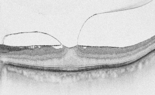 Seitenansicht einer epiretinalen Gliose (macular pucker)
