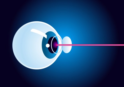 Schemadarstellung Laser und Auge